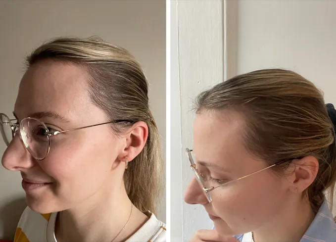 the ordinary hair serum review before and after katherine' fetchpriority='auto' title='3 Editors Try The Ordinary Hair Serum. Here Are Their Honest Takes