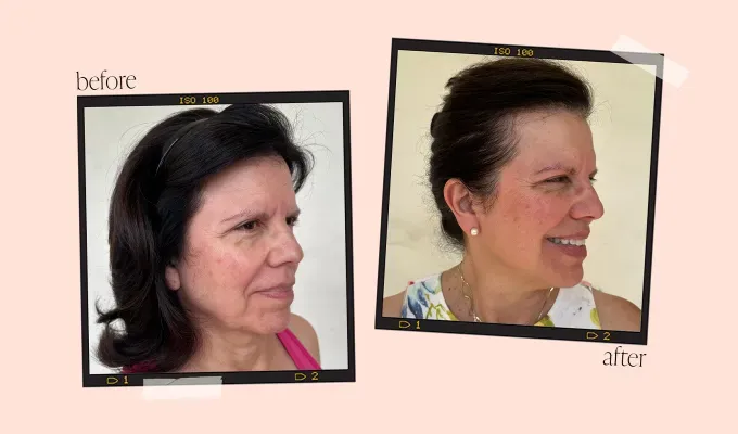 omnilux-contour-face-mask-review meraz before and after pictures' fetchpriority='auto' title='My 61-Year-Old Mom Reviewed the Omnilux Contour Face Mask to See If It Could Reverse the Wrinkles I Caused Her