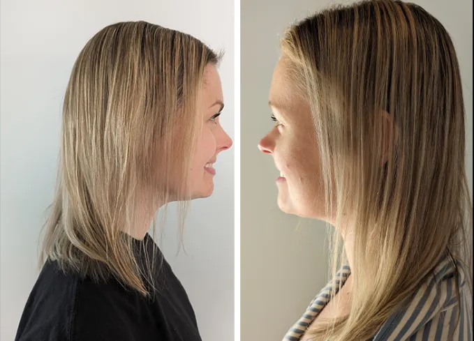 the ordinary hair serum review: before and after for PureWow VP of Editorial Candace Davison' fetchpriority='auto' title='3 Editors Try The Ordinary Hair Serum. Here Are Their Honest Takes