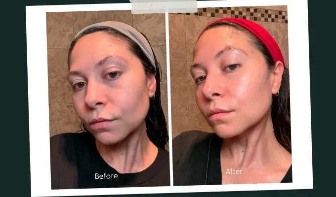 Lyma Laser Review: Original before and after photos of Stephanie Maida' title='I Tried the Celebrity-Loved Lyma Laser for 40 Days—Is It Worth the Hype?